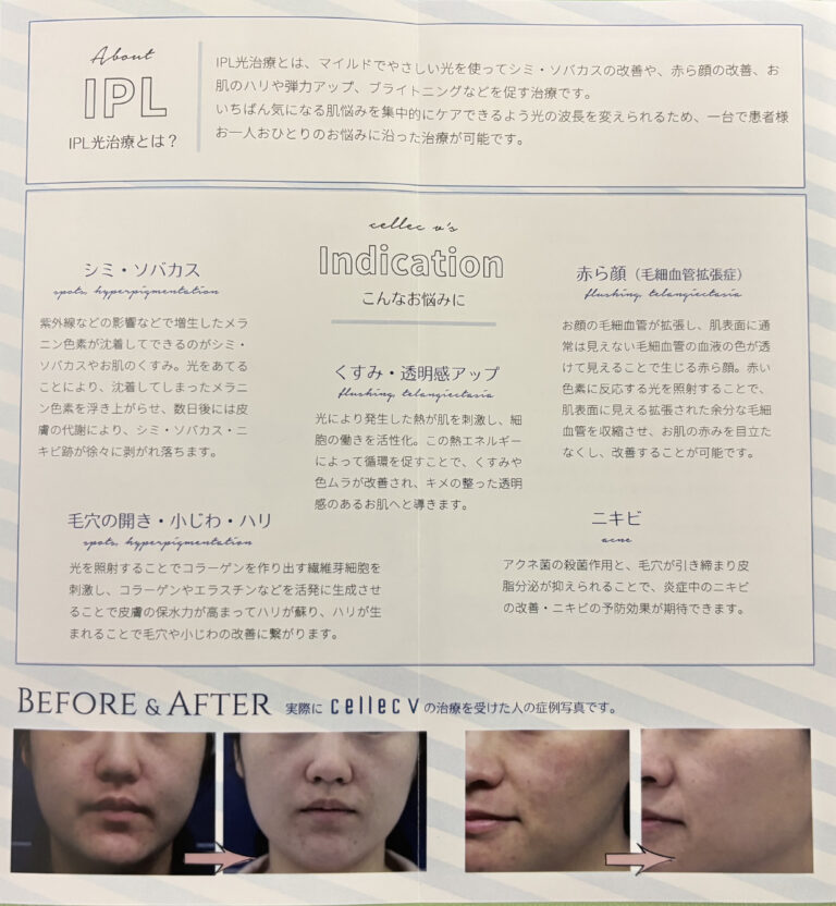 セレックVの案内